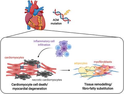 Inflammation in the Pathogenesis of Arrhythmogenic Cardiomyopathy: Secondary Event or Active Driver?